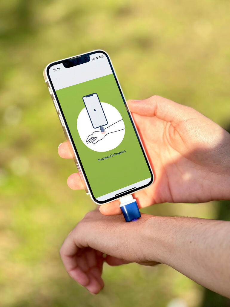 Smartphone-Insektenstichheiler wird am Handgelenk verwendet